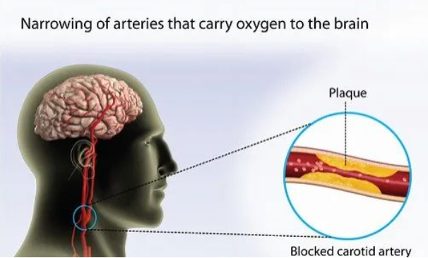 最怕堵的一根血管，严重可致命！